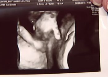 Συγκλονιστικό! Έμβρυο αποχαιρετάει το δίδυμο αδελφάκι του που πεθαίνει(Video)