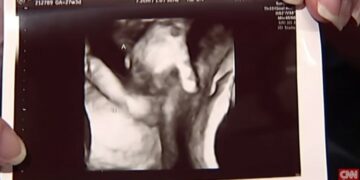 Συγκλονιστικό! Έμβρυο αποχαιρετάει το δίδυμο αδελφάκι του που πεθαίνει(Video)
