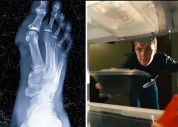 Alldaynews.gr Φοιτητής έπρεπε να υποστεί ακρωτηριασμό των άκρων του αφού έφαγε χθεσινό φαγητό από το ψυγείο