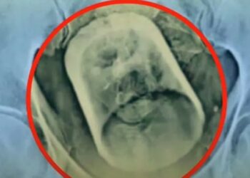 Άντρας βρέθηκε με γυάλινο ποτήρι στο έντερο: Έπινα τσάι και το κατάπια, είπε στον γιατρό