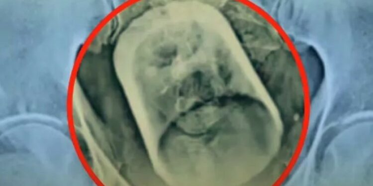 Alldaynews.gr Άντρας βρέθηκε με γυάλινο ποτήρι στο έντερο: Έπινα τσάι και το κατάπια, είπε στον γιατρό