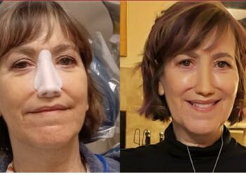 Έπρεπε να αφαιρέσω τη μύτη μου ή να παλέψω με τον θάνατο, σήμερα όμως αισθάνομαι τυχερή