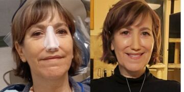 Έπρεπε να αφαιρέσω τη μύτη μου ή να παλέψω με τον θάνατο, σήμερα όμως αισθάνομαι τυχερή