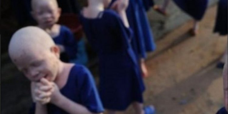 Φρίκη: Σκότωσαν και διαμέλισαν 4χρονο αλμπίνο για να μοιραστούν τα οστά του