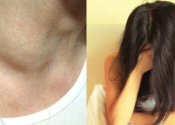 Προσοχή: «Οι γιατροί 5 χρόνια με καθησύχαζαν για το πρησμένο σημείο στο σώμα μου και τελικά ήταν καρκίνος»