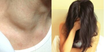 Alldaynews.gr Προσοχή: «Οι γιατροί 5 χρόνια με καθησύχαζαν για το πρησμένο σημείο στο σώμα μου και τελικά ήταν καρκίνος»