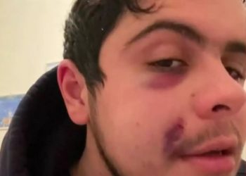 «Χούλιγκαν με σακάτεψαν στο ξύλο στη μέση του δρόμου» – Σοκάρουν οι εικόνες μετά την επίθεση σε 23χρονο (video)