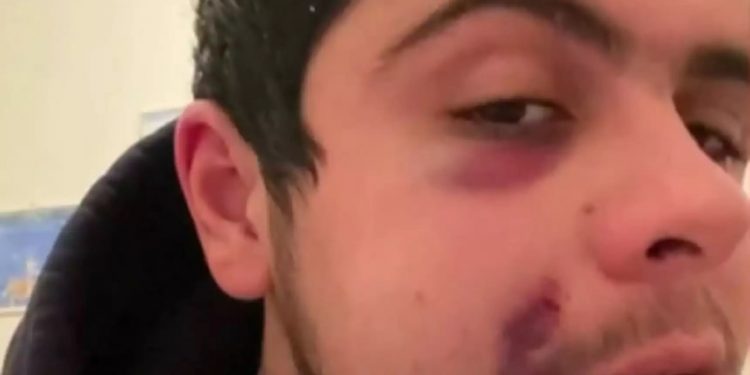 Alldaynews.gr «Χούλιγκαν με σακάτεψαν στο ξύλο στη μέση του δρόμου» – Σοκάρουν οι εικόνες μετά την επίθεση σε 23χρονο (video)