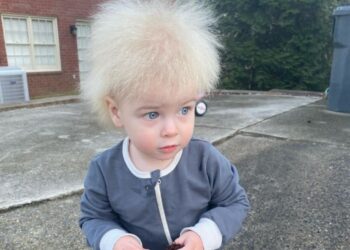 Αγοράκι με «σύνδρομο μαλλιών που δεν χτενίζονται» έχει γίνει viral[photos]