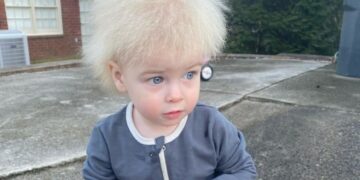 Αγοράκι με «σύνδρομο μαλλιών που δεν χτενίζονται» έχει γίνει viral[photos]