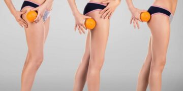 Alldaynews.gr Κυτταρίτιδα: Οι ασκήσεις που την «εξαφανίζουν»