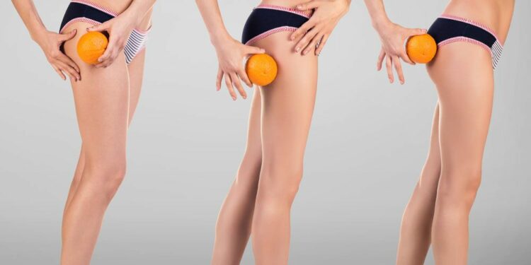 Alldaynews.gr Κυτταρίτιδα: Οι ασκήσεις που την «εξαφανίζουν»