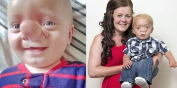 Alldaynews.gr O Πινόκιο της πραγματική ζωής: Το παιδί που ο εγκέφαλός του μεγαλώνει στη μύτη του