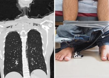 Άνδρας έφτασε ετοιμοθάνατος στην εντατική με «διαλυμένους» πνεύμονες γιατί… αυνανίστηκε πολύ σκληρά