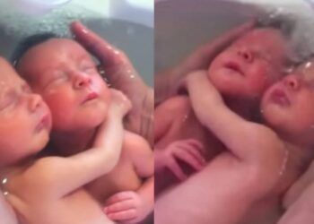 Δίδυμα δεν έχουν καταλάβει ότι γεννήθηκαν και παραμένουν αγκαλιασμένα όπως ήταν μέσα στην κοιλιά της μαμάς τους