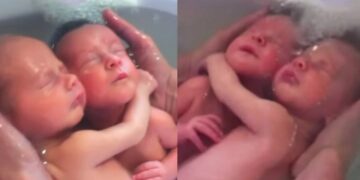 Δίδυμα δεν έχουν καταλάβει ότι γεννήθηκαν και παραμένουν αγκαλιασμένα όπως ήταν μέσα στην κοιλιά της μαμάς τους