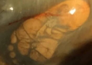 Ήταν 9 μηνών έγκυος, αλλά δεν πήγε ποτέ στον γιατρό για εξετάσεις-Αυτό που έδειξε ο 1ος υπέρηχος, την έκανε να παγώσει!