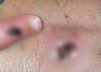 Alldaynews.gr Ευλογιά των πιθήκων: Αυτά είναι τα συμπτώματα-«Ο ιός θα εξαπλωθεί στην Ευρώπη το καλοκαίρι»