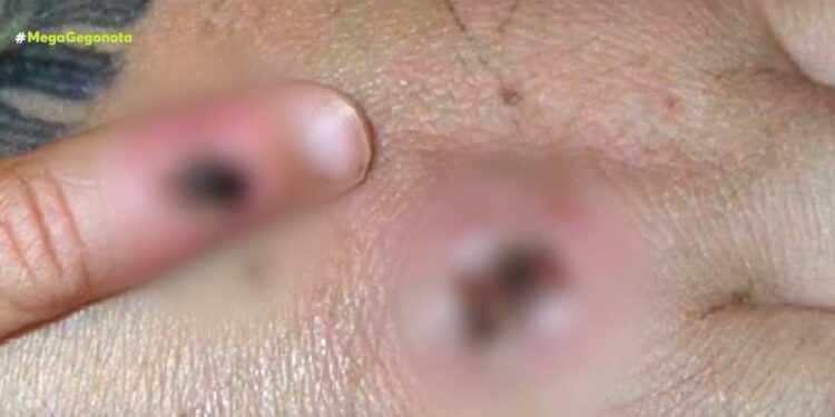 Alldaynews.gr Ευλογιά των πιθήκων: Αυτά είναι τα συμπτώματα-«Ο ιός θα εξαπλωθεί στην Ευρώπη το καλοκαίρι»