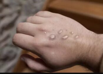 Alldaynews.gr Ευλογιά των πιθήκων: Πώς μεταδίδεται-Με ποια σειρά εμφανίζονται τα συμπτώματα