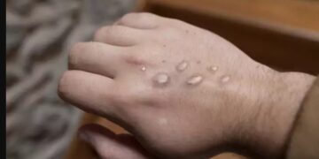 Alldaynews.gr Ευλογιά των πιθήκων: Πώς μεταδίδεται-Με ποια σειρά εμφανίζονται τα συμπτώματα