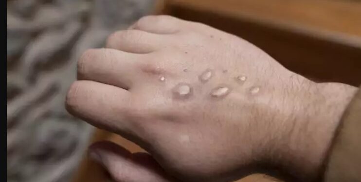 Alldaynews.gr Ευλογιά των πιθήκων: Πώς μεταδίδεται-Με ποια σειρά εμφανίζονται τα συμπτώματα