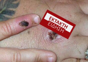 ΕΚΤΑΚΤΟ-Ευλογιά των πιθήκων! Εντοπίστηκε ύποπτο κρούσμα στην Ελλάδα-Που βρέθηκε[Περιοχή]