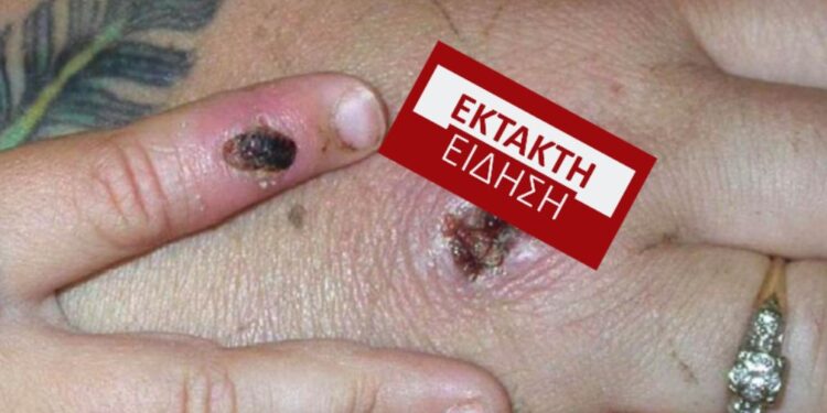 ΕΚΤΑΚΤΟ-Ευλογιά των πιθήκων! Εντοπίστηκε ύποπτο κρούσμα στην Ελλάδα-Που βρέθηκε[Περιοχή]