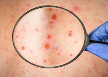 Alldaynews.gr Ευλογιά των πιθήκων-Τζανάκης: Προσοχή με το κρέας που τρώμε