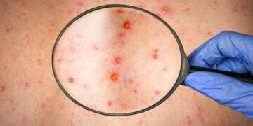 Alldaynews.gr Ευλογιά των πιθήκων-Τζανάκης: Προσοχή με το κρέας που τρώμε