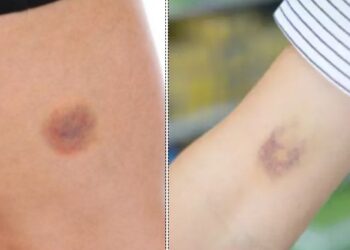 Προσοχή αν εμφανιστούν μώλωπες στο σώμα σας: Τι Μπορεί να σας συμβεί-Γρήγορα στον γιατρό σας