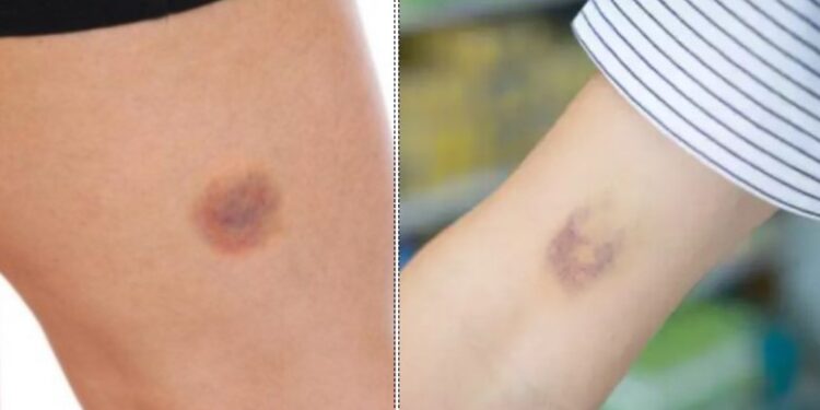 Alldaynews.gr Προσοχή αν εμφανιστούν μώλωπες στο σώμα σας: Τι Μπορεί να σας συμβεί-Γρήγορα στον γιατρό σας