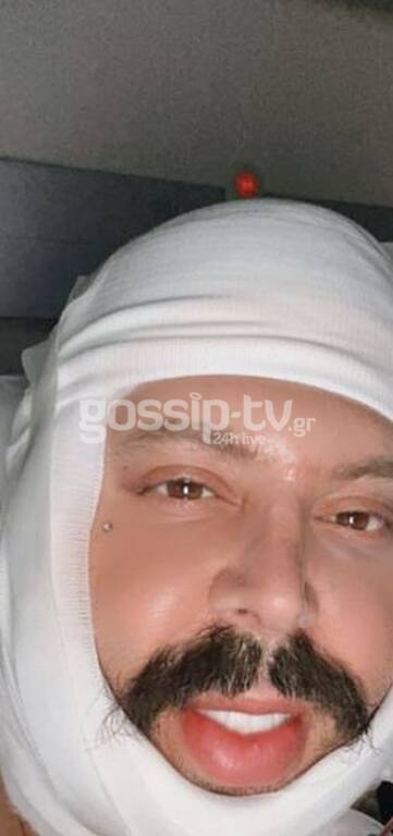 Big Brother: Αγνώριστος ο Νικόλας μετά τις πλαστικές - Αποκλειστικές φωτό μέσα από το νοσοκομείο