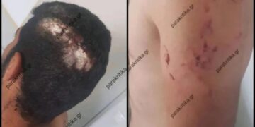 Κρήτη: Υπάλληλος ζήτησε τον μισθό του και στο δρόμο για το Τμήμα τον βρήκε ο εργοδότης και τον σακάτεψε (φωτο)