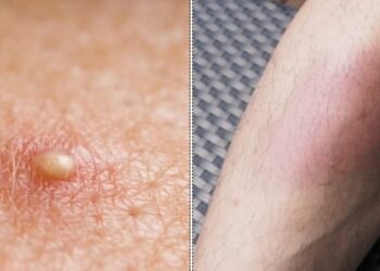 Σημάδια στο δέρμα: 10 “αθώα” συμπτώματα στην επιδερμίδα δείχνουν πως κάτι δεν πάει καλά με την υγεία μας