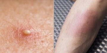 Alldaynews.gr Σημάδια στο δέρμα: 10 “αθώα” συμπτώματα στην επιδερμίδα δείχνουν πως κάτι δεν πάει καλά με την υγεία μας