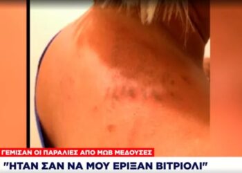 «Δεν μπορείς να περιγράψεις τον πόνο»: Τι δήλωσε γυναίκα που τσιμπήθηκε από μωβ μέδουσα