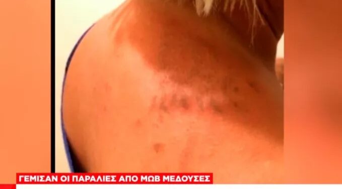 Alldaynews.gr «Δεν μπορείς να περιγράψεις τον πόνο»: Τι δήλωσε γυναίκα που τσιμπήθηκε από μωβ μέδουσα