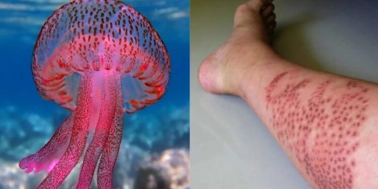 Alldaynews.gr Απαγορεύονται αμμωνία και ξύδι: Τι κάνετε αν σας τσιμπήσει Μωβ Μέδουσα-Πότε πάτε σε γιατρό