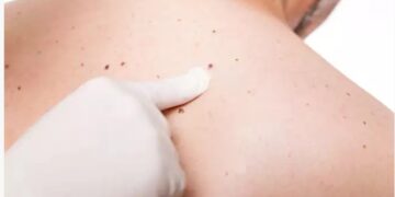 Αν δείτε αυτό στο δέρμα σας, κάντε εξέταση για καρκίνο