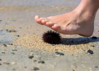 Προσοχή! Δεν είναι απλό-Τι να κάνετε αν πατήσετε αχινό