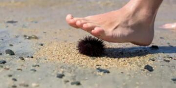 Alldaynews.gr Προσοχή! Δεν είναι απλό-Τι να κάνετε αν πατήσετε αχινό