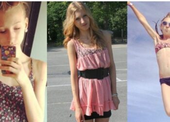 18χρονη ζύγιζε 31 κιλά και ζούσε μόνο με νερό και τσίχλες – Σήμερα η εικόνα της σoκάρει οικογένεια και φίλους