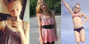 18χρονη ζύγιζε 31 κιλά και ζούσε μόνο με νερό και τσίχλες – Σήμερα η εικόνα της σoκάρει οικογένεια και φίλους