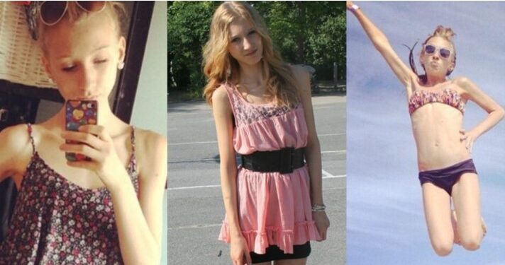 18χρονη ζύγιζε 31 κιλά και ζούσε μόνο με νερό και τσίχλες – Σήμερα η εικόνα της σoκάρει οικογένεια και φίλους