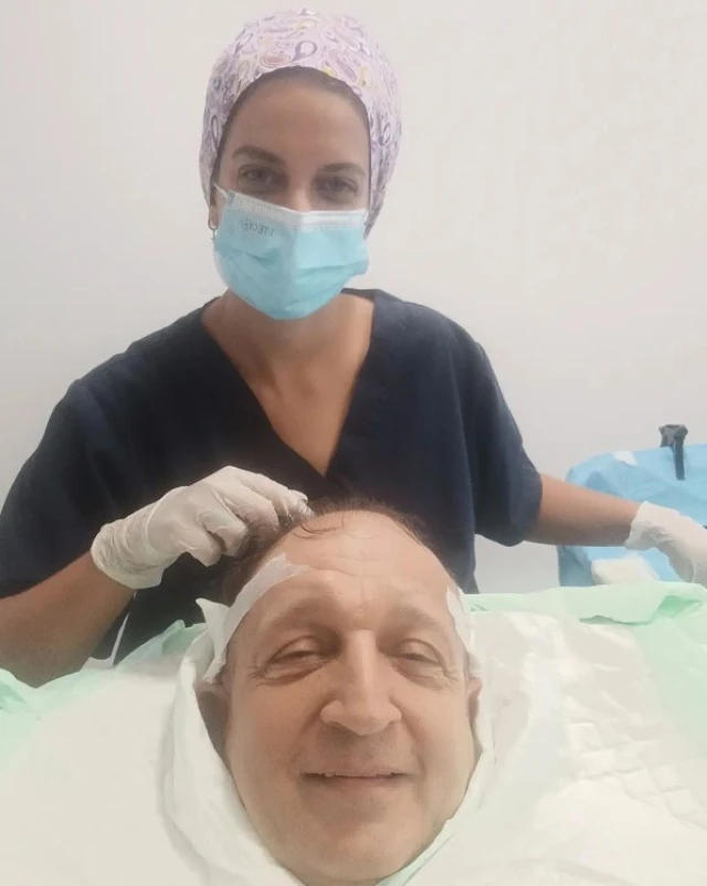 Σπύρος Μπιμπίλας: Έκανε μεταμόσχευση μαλλιών και ανέβασε τις φωτογραφίες στα social media