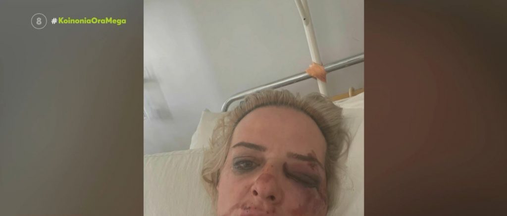 Άγρια επίθεση αδέσποτων σε νεαρή γυναίκα(Εικόνες Σοκ)