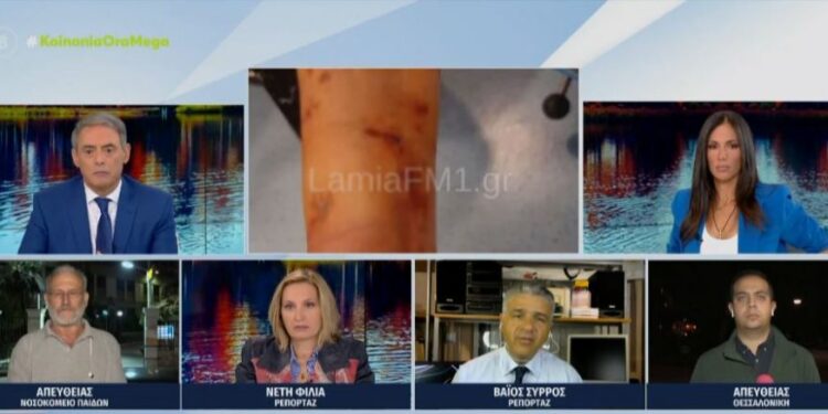 Λαμία: Σκύλος κατασπάραξε 35χρονη – Υπέστη κάταγμα το δεξί χέρι της