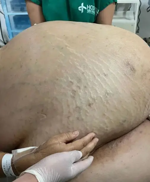 Ζούσε για πέντε χρόνια με έναν όγκο 45 κιλών στο στομάχι—Έμειναν έκπληκτοι οι γιατροί[Εικόνες Σοκ]