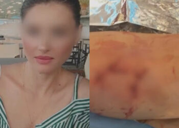 Σε κατάσταση σοκ νοσηλεύεται η 34χρονη: «Με κατασπάραξαν – Με δάγκωσαν παντού, έχω μώλωπες και ράμματα»